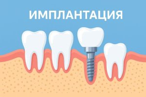 Имплантат: повторная установка - миф или реальность?
