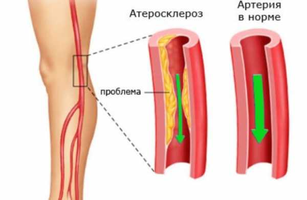 Атеросклероз сосудов нижних