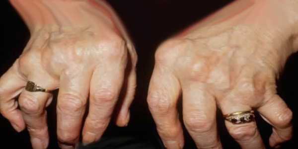 Болят кисти рук тяжело сгибать пальцы