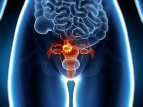 Что такое рак шейки матки и как он проявляется