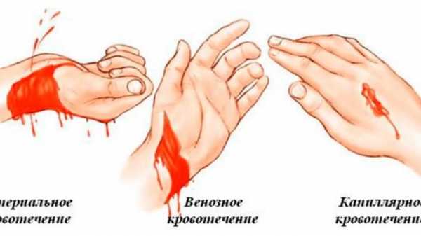 Характеристика артериального кровотечения