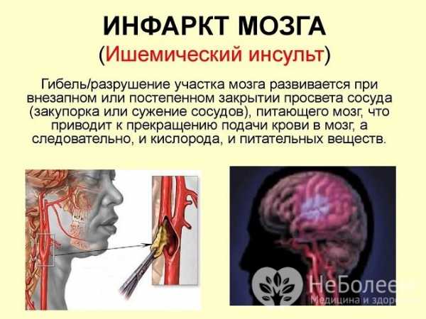 Инфаркт мозга вызванный тромбозом мозговых артерий