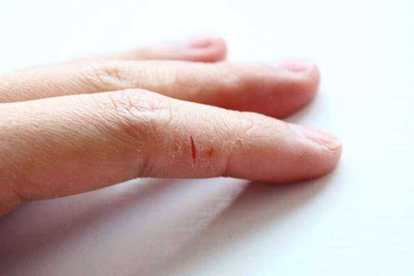 Почему кожа на пальцах трескается