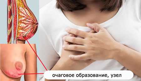 Узловая мастопатия молочной железы лечение