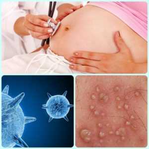 Вирус герпеса и беременность