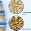 Лечение остеопороза народными средствами