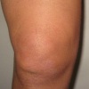 Основные виды синовита коленного сустава и характерные симптомы