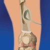 Классификация и клиническое течение остеомиелита костей