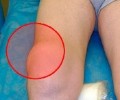 Гигрома коленного сустава: признаки и методики лечения