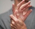Причины, симптомы и лечение полиартрита пальцев рук
